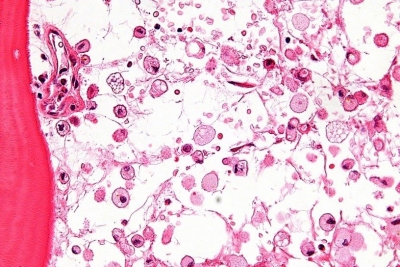 Malattia di Gaucher